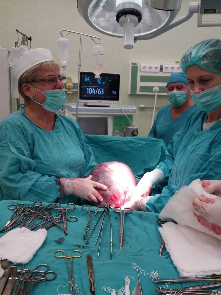 Pacienta cu tumoră abdominală a fost operată