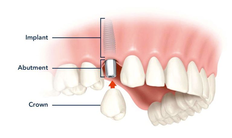 Cum se pune un implant dentar şi alte informaţii despre cea mai eficientă metodă de acoperire a golurilor dentare