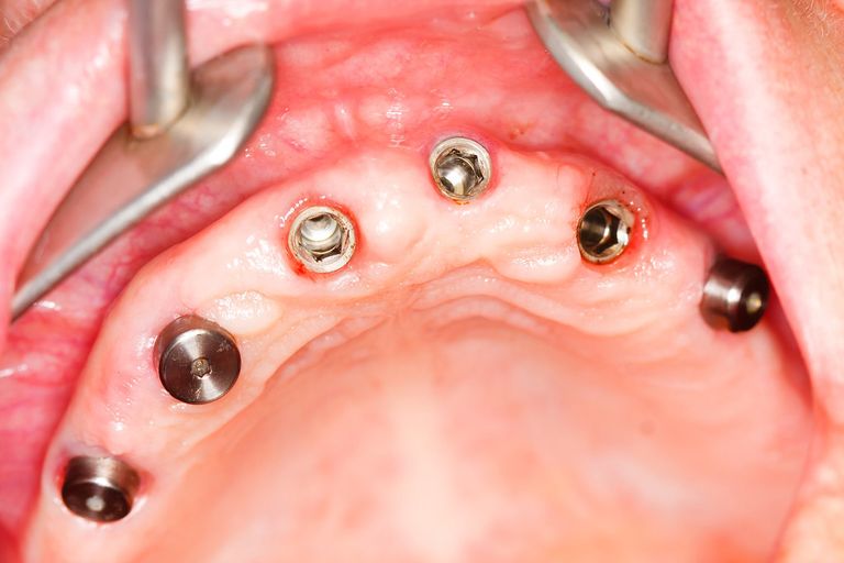 Ce este un implant dentar pentru toată gura?
