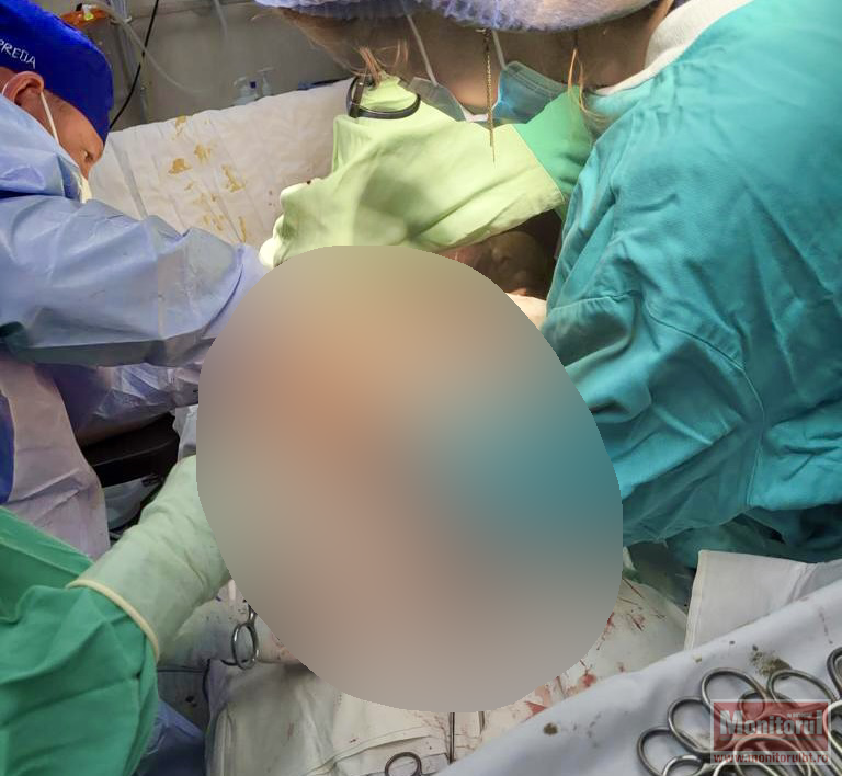 Tumoră gigant operată de chirurgii botoșăneni