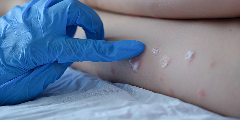 Al treilea caz de variola maimuței, diagnosticat în România