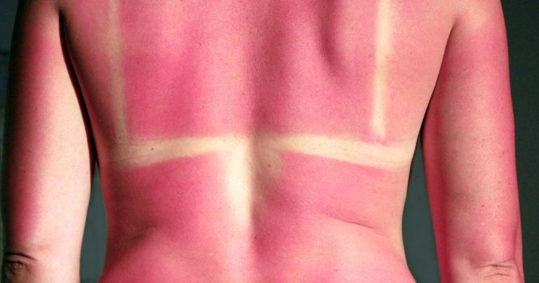 Avertisment din partea unui medic botoşănean: Arsurile solare pot duce la spitalizare și chiar cancer de piele (VIDEO)